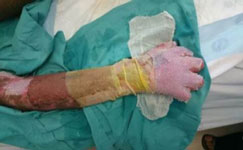 Kleintjes skin graft next day burn, reconstruction, skin graft, dr wayne kleintjes, tygerberg 
hospital, western cape department of health