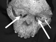 The Taung skull, showing injuries to its eye sockets inflicted by a large bird of prey 